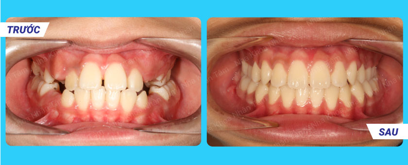 Khách hàng trước và sau niềng răng tại nha khoa Nhân Tâm